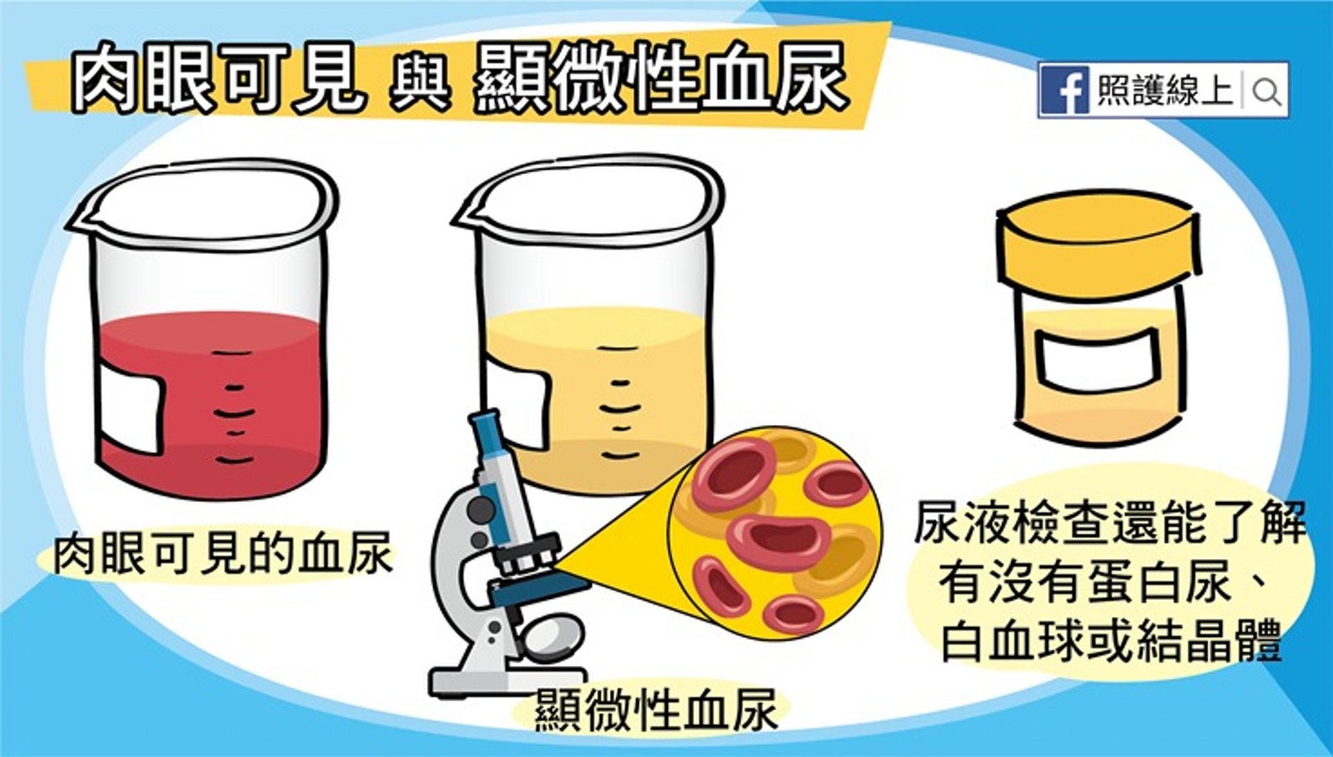 肉眼可見與顯微性血尿(照護線上授權使用) 肉眼可見與顯微性血尿(照護線上授權使用)