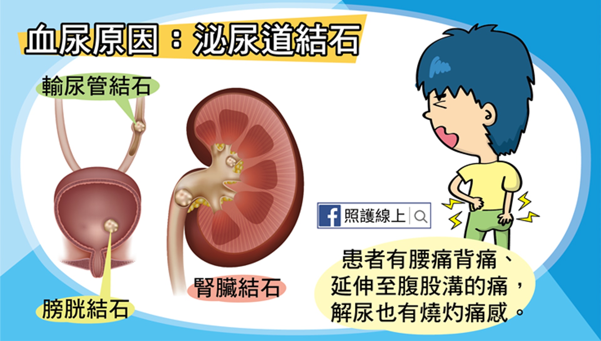 血尿原因:泌尿道結石(照護線上授權使用) 血尿原因:泌尿道結石(照護線上授權使用)