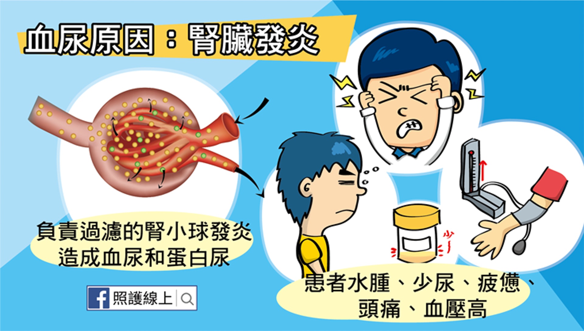 血尿原因:腎臟發炎(照護線上授權使用) 血尿原因:腎臟發炎(照護線上授權使用)