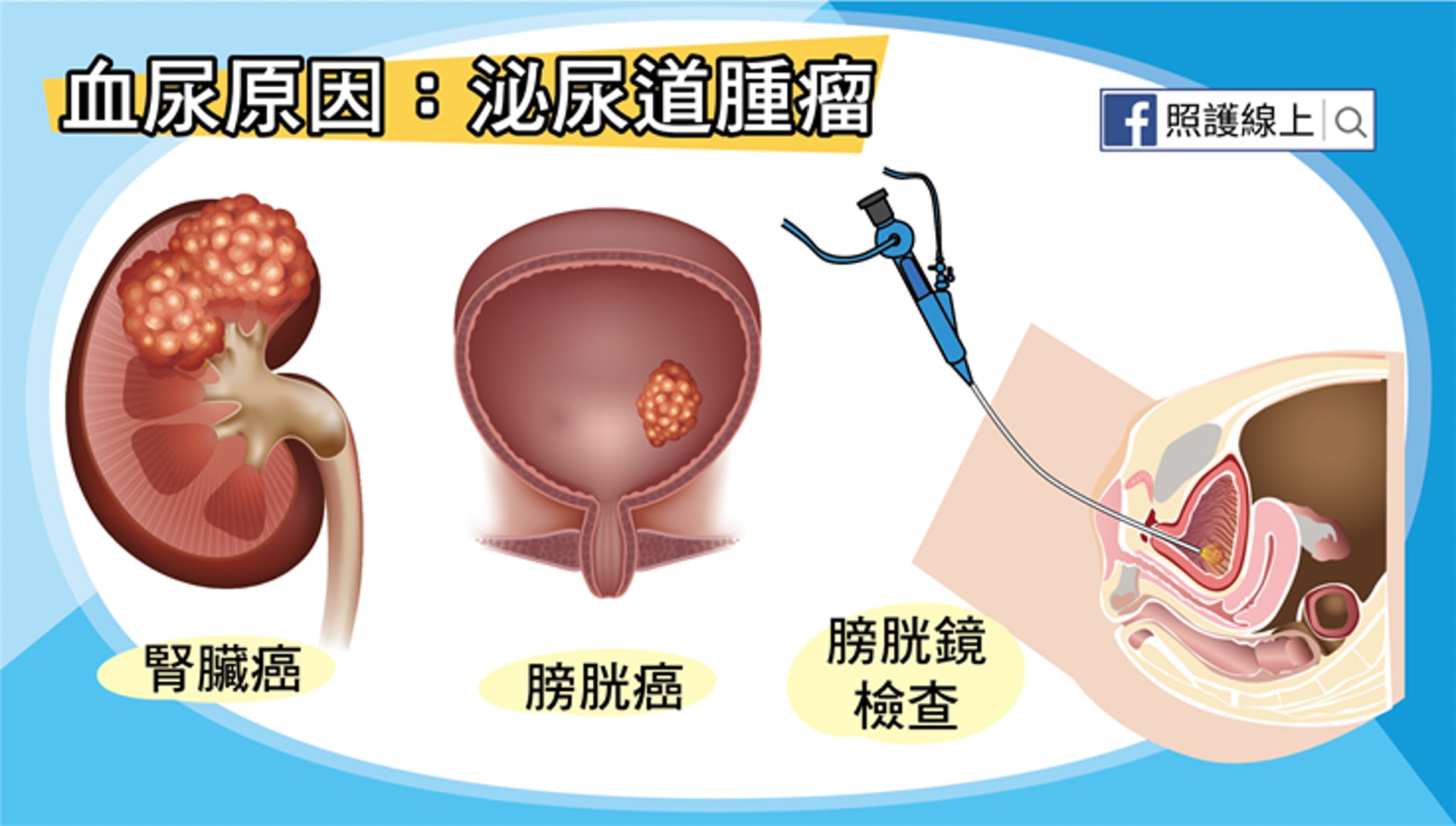 血尿原因：泌尿道腫瘤（照護線上授權使用）