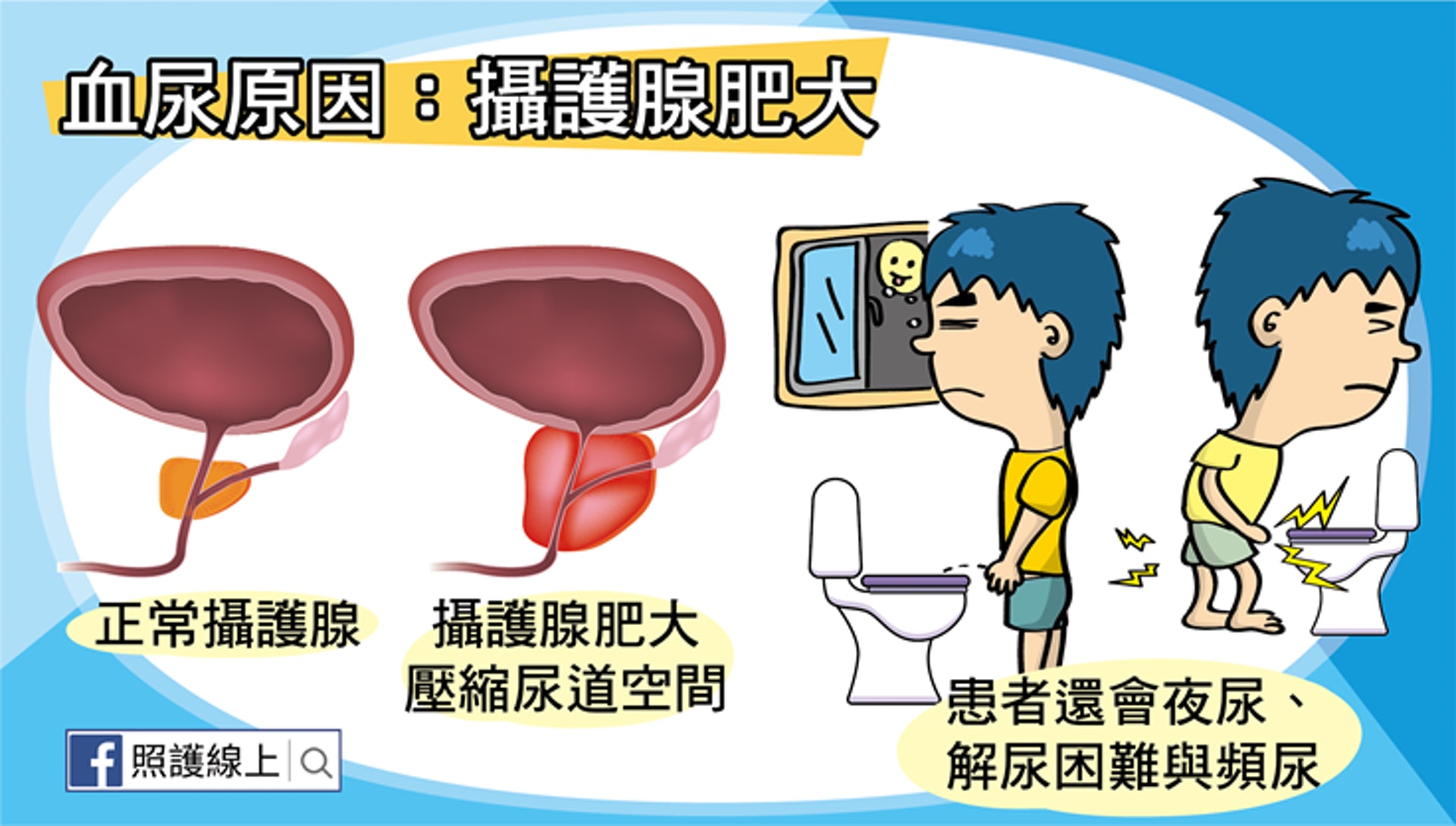 血尿原因：攝護腺肥大（照護線上授權使用）