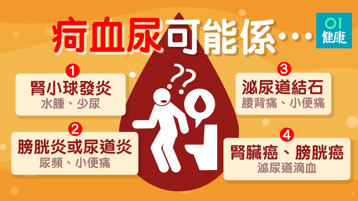 血尿 尿液為什麼變紅色 腎炎 泌尿感染或腫瘤可能血尿成因 香港01 健康