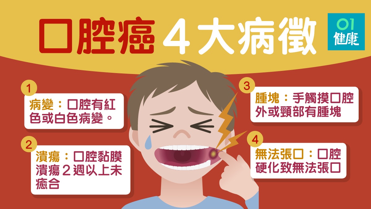 口腔癌 口腔潰瘍兩星期不癒合勿輕視一文看清口腔癌4大病徵 香港01 健康 口腔癌 口腔潰瘍兩星期不癒合勿輕視一文看清口腔癌4大病徵 香港01 健康