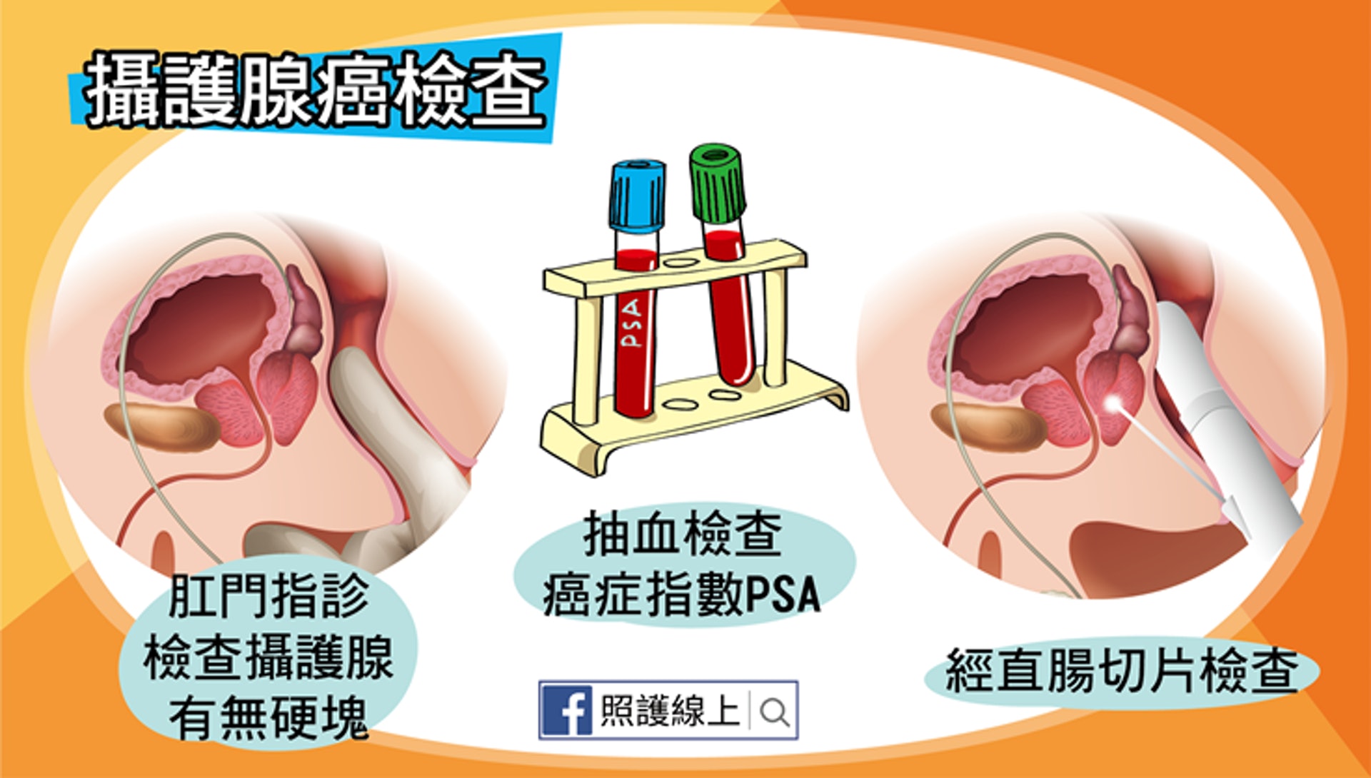 前列腺癌檢查（照護線上授權使用）