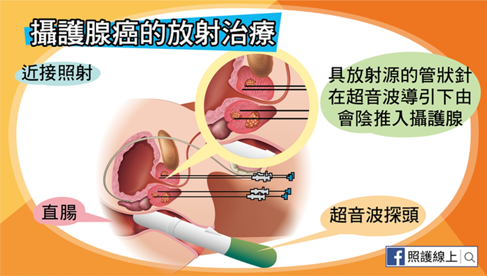 前列腺癌的放射治療(照護線上授權使用) 前列腺癌的放射治療(照護線上授權使用)