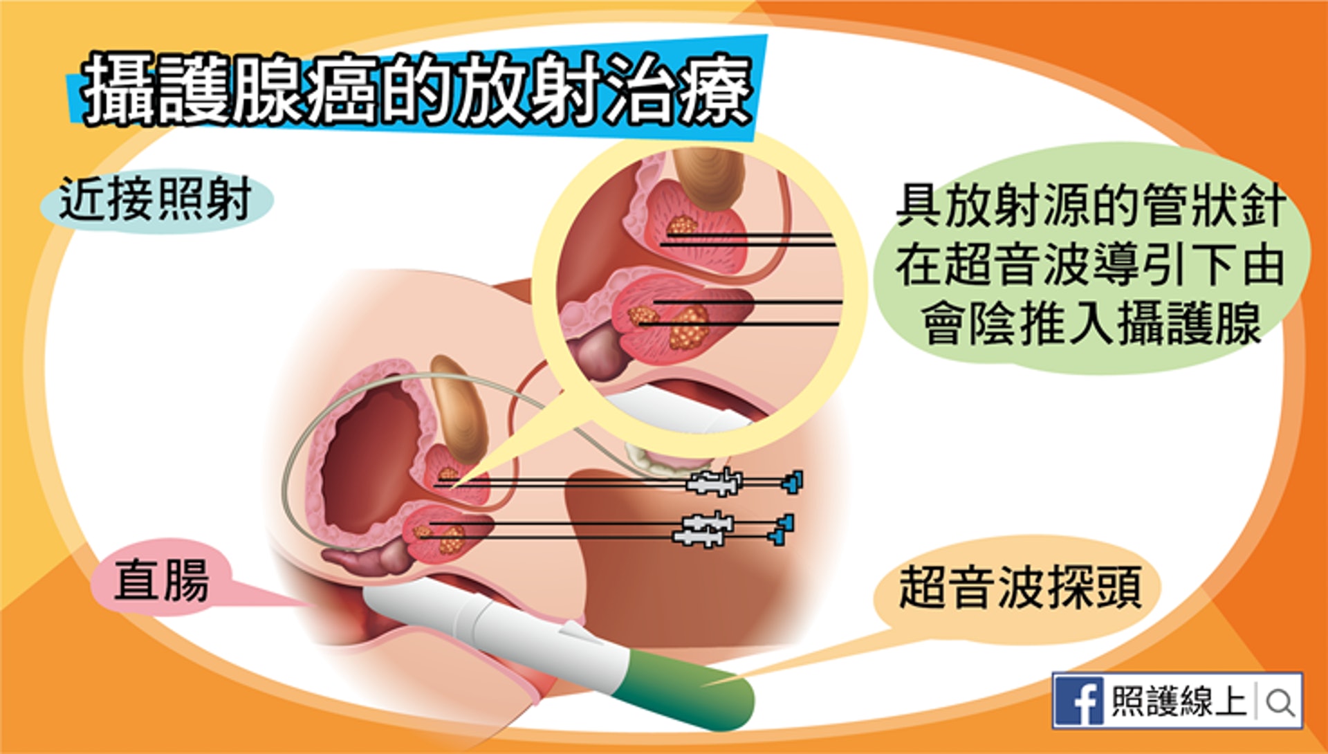 前列腺癌的放射治療（照護線上授權使用）