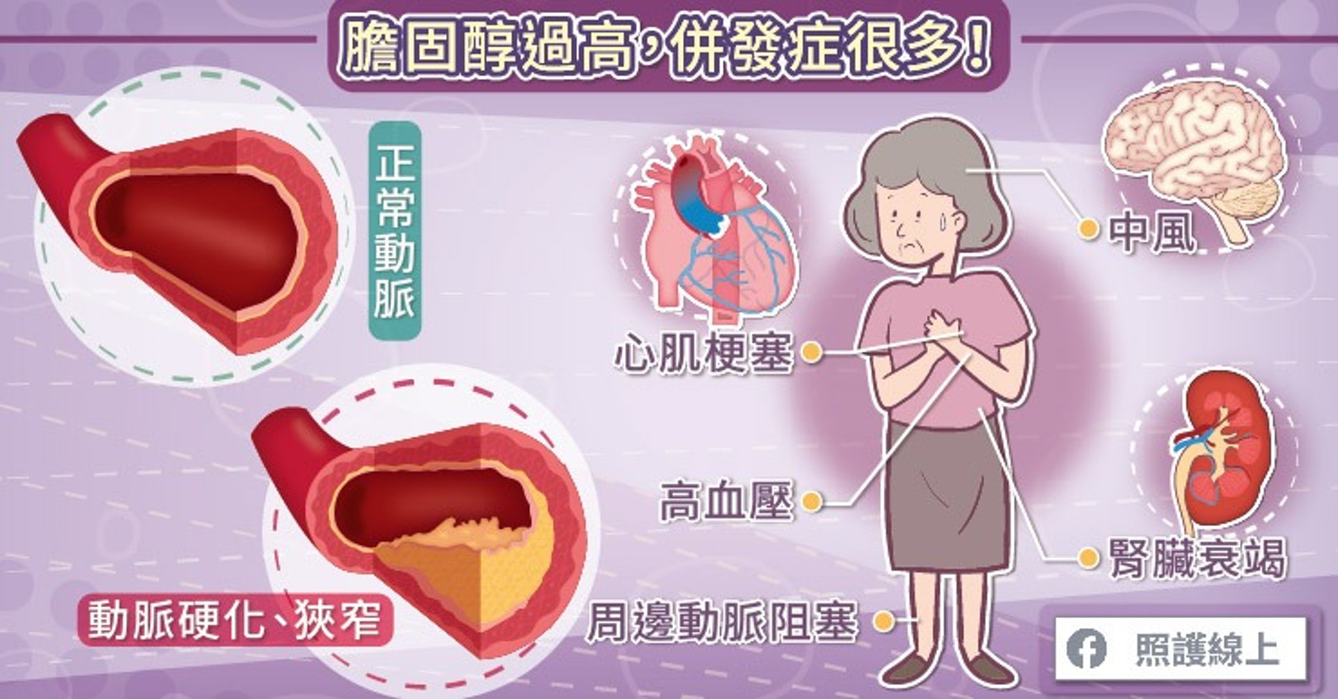 膽固醇過高,併發症很多!(照護線上授權使用) 膽固醇過高,併發症很多!(照護線上授權使用)