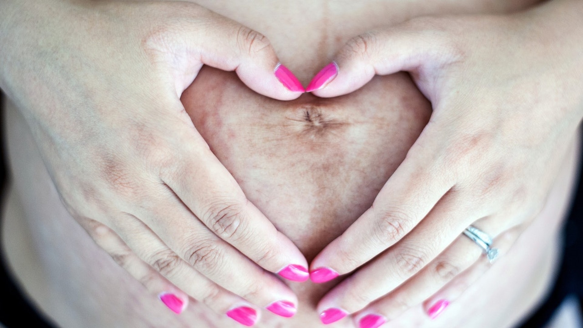 初產婦腹壁的紫紅色妊娠紋會變成銀白色陳舊妊娠紋。（資料圖片）