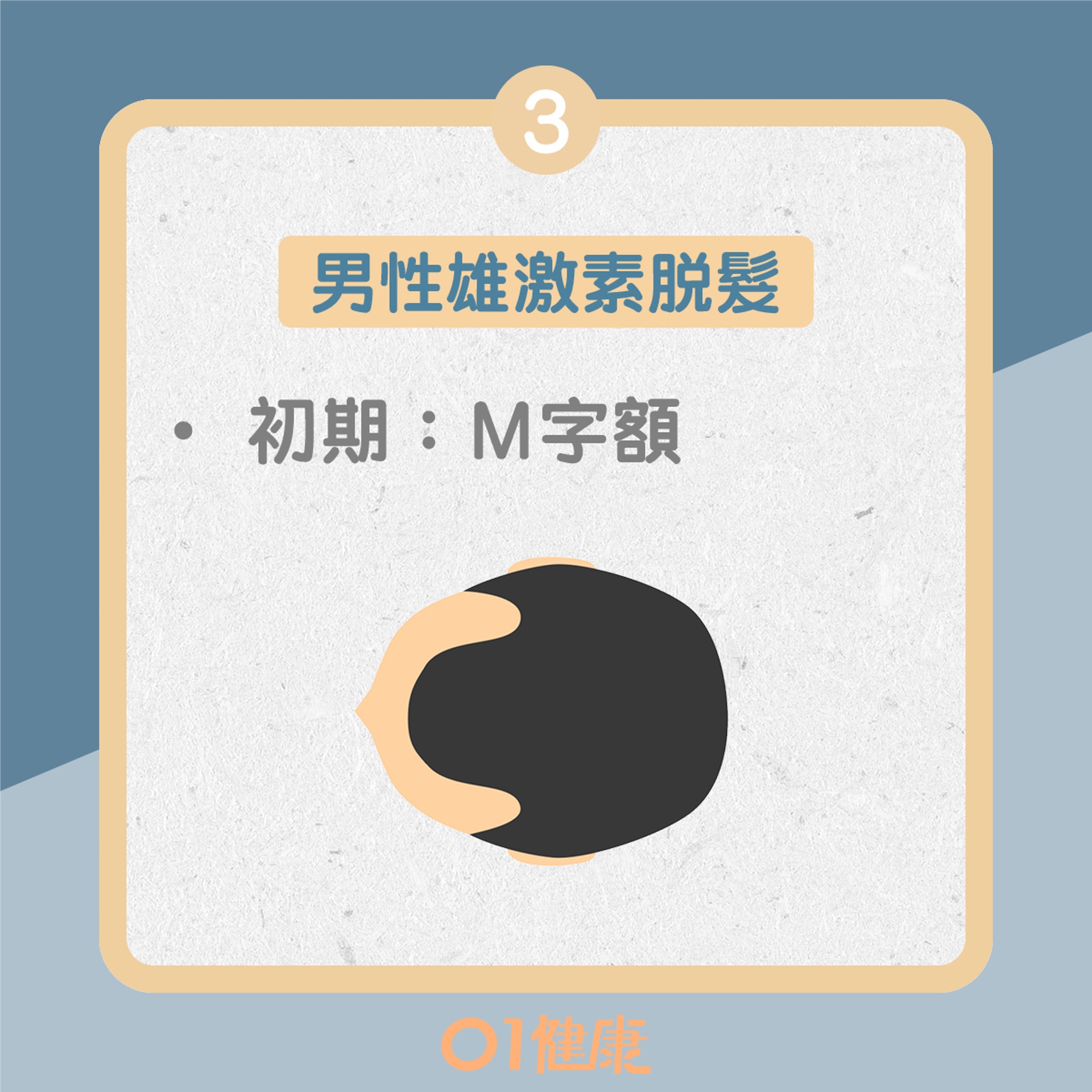 雄激素性脫髮(01製圖) 雄激素性脫髮(01製圖)