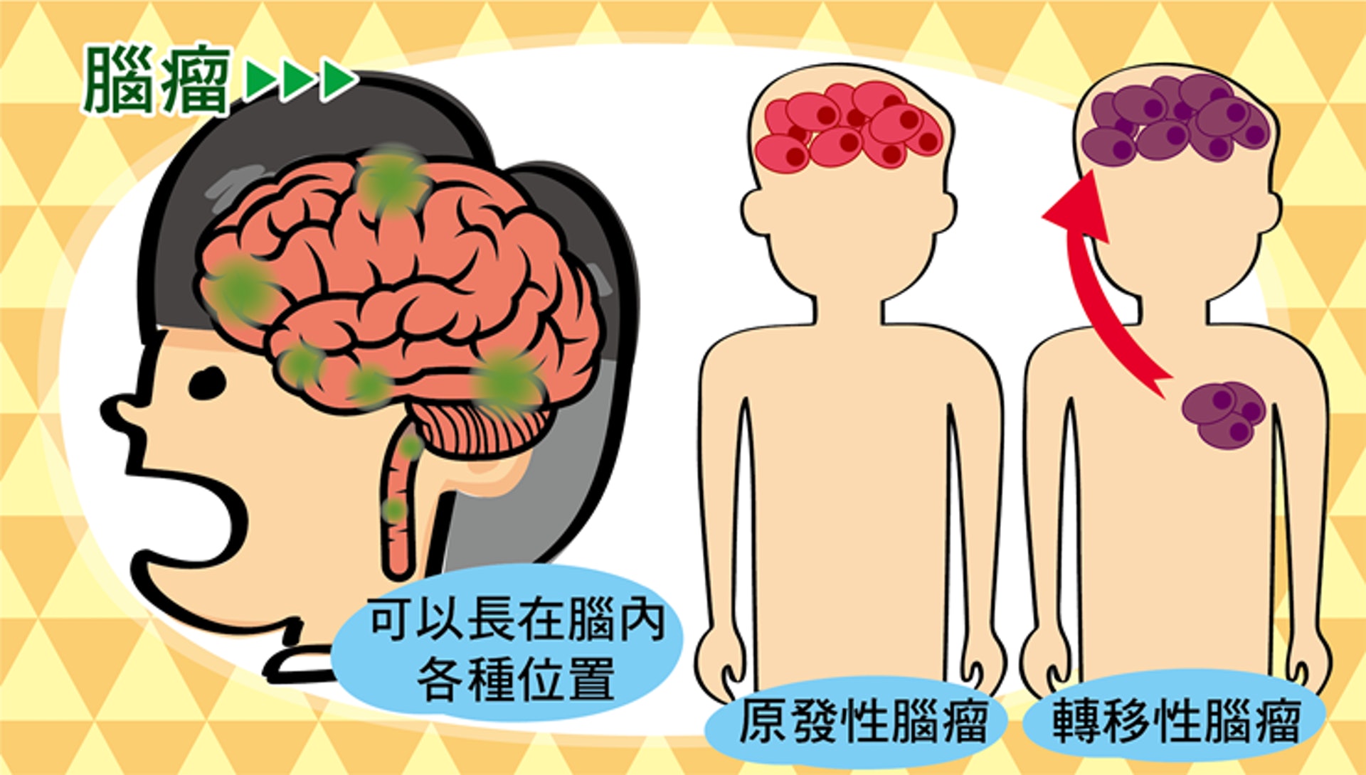 有些腦瘤是原發自腦內的細胞,我們稱為原發性腦腫瘤,有些則是其他部位的癌細胞轉移到腦部後,長出的續發性或轉移性腦腫瘤。(照護線上授權使用) 有些腦瘤是原發自腦內的細胞,我們稱為原發性腦腫瘤,有些則是其他部位的癌細胞轉移到腦部後,長出的續發性或轉移性腦腫瘤。(照護線上授權使用)