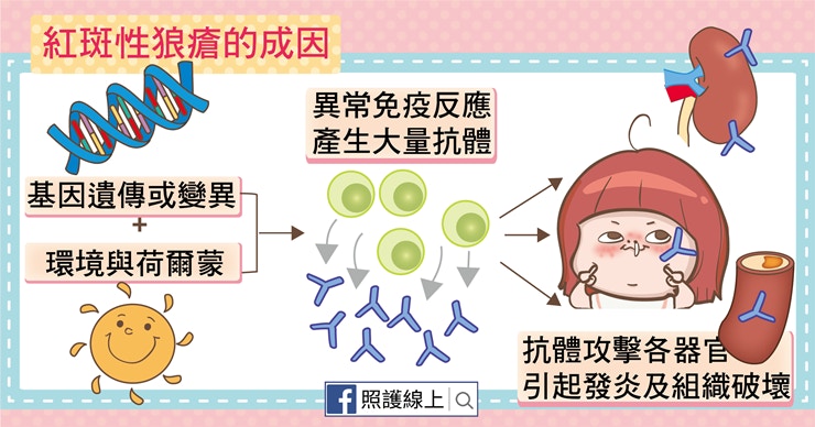 紅斑性狼瘡的成因（照護線上授權使用）