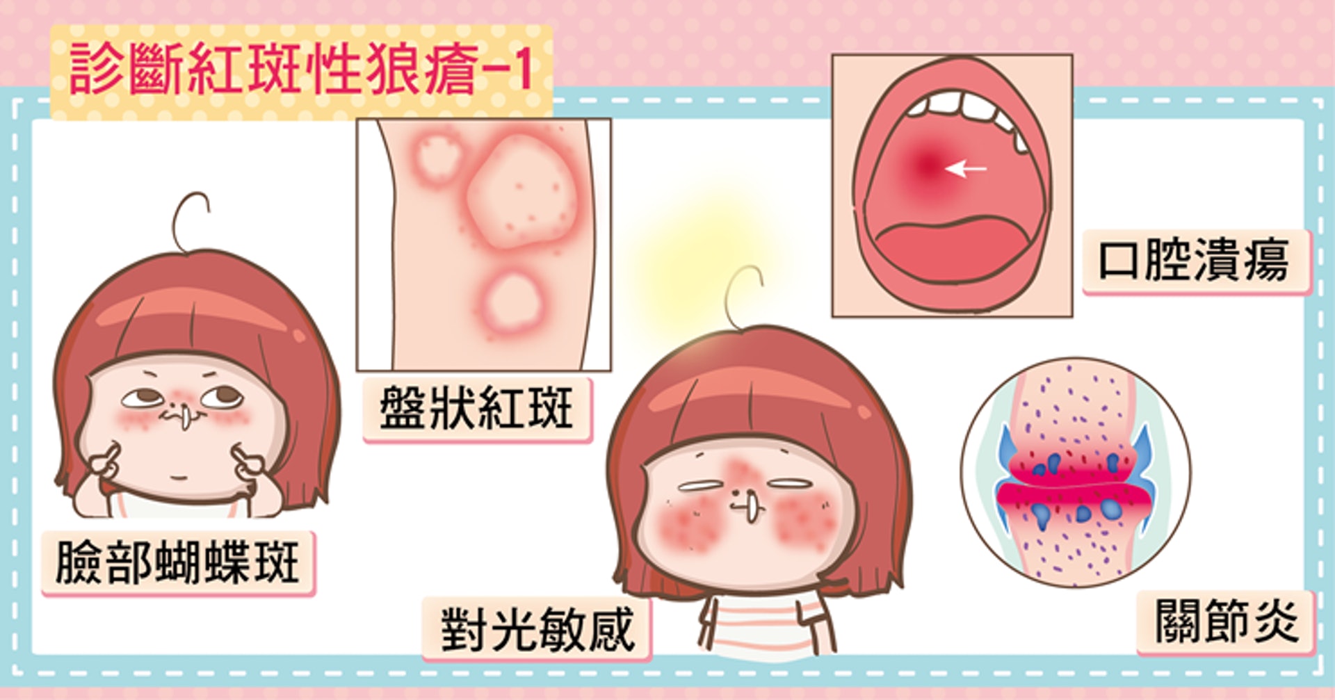 診斷紅斑性狼瘡(照護線上授權使用) 診斷紅斑性狼瘡(照護線上授權使用)