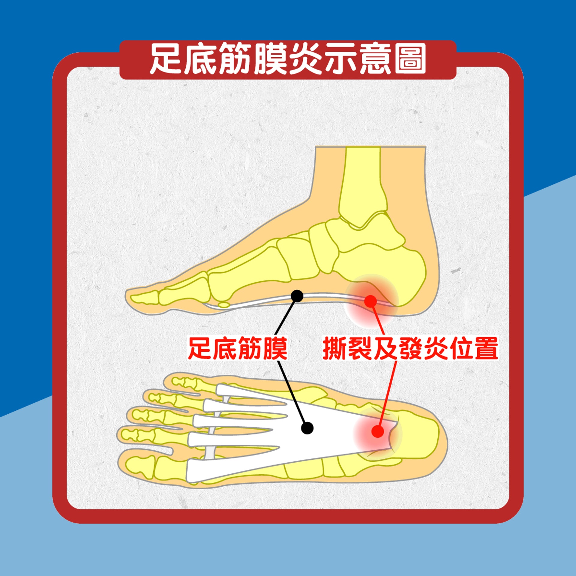足底筋膜炎示意圖（01製圖）