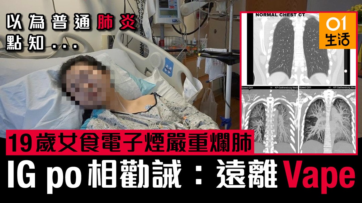 美少女吸電子煙吸爛肺險死 呼吸系統嚴重損傷IG上載雙肺掃描警世 美少女吸電子煙吸爛肺險死 呼吸系統嚴重損傷IG上載雙肺掃描警世
