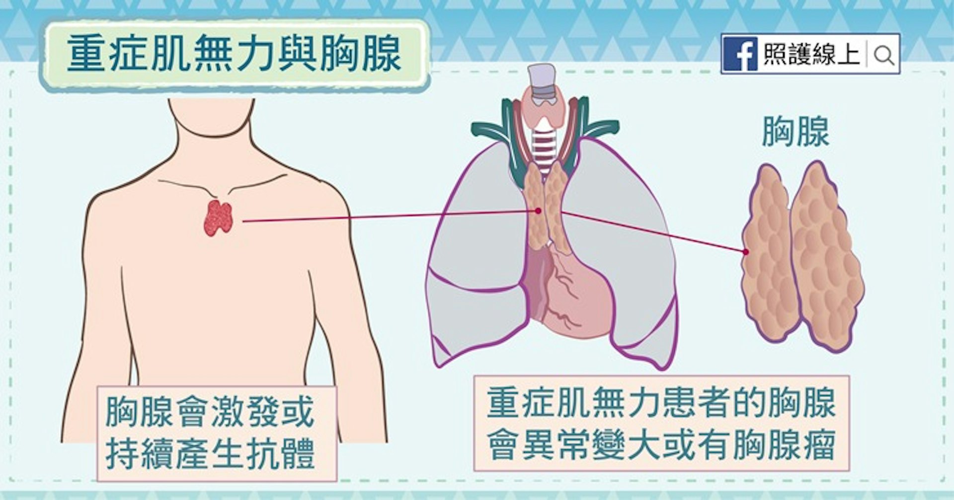 重症肌無力與胸線(照護線上授權使用) 重症肌無力與胸線(照護線上授權使用)