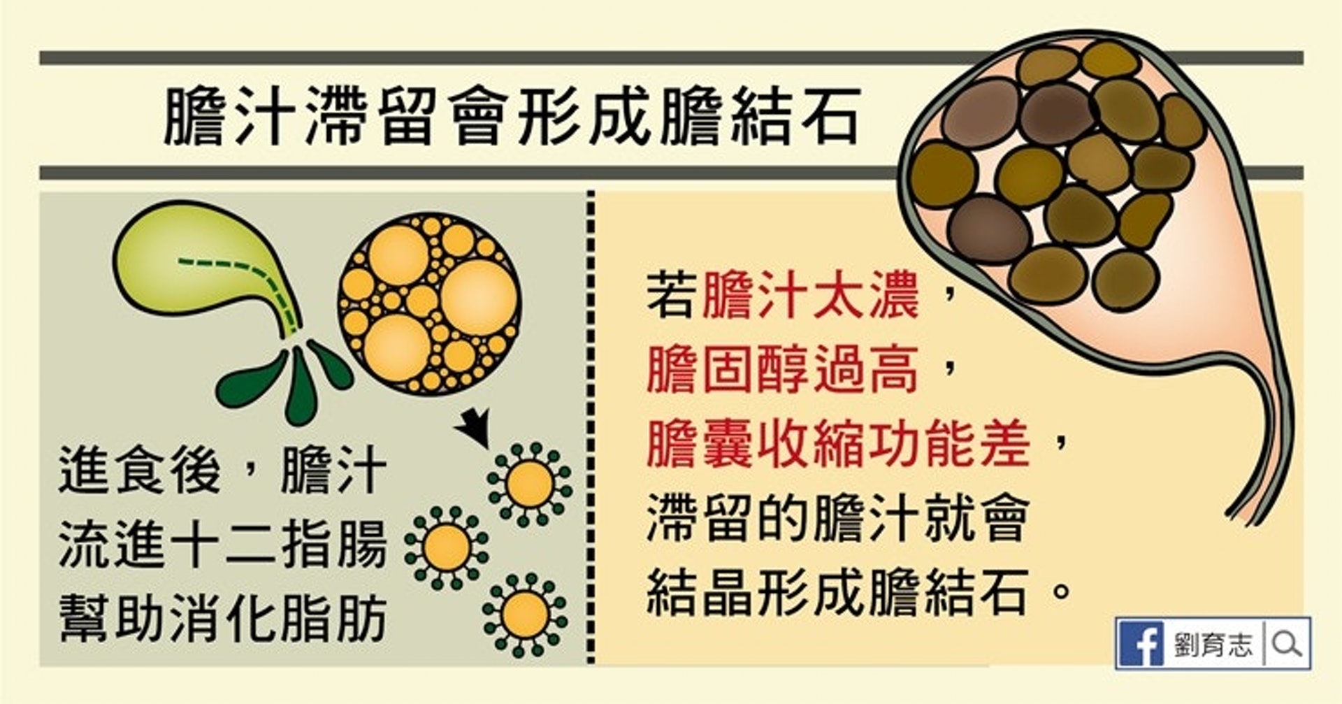 滯留的膽汁結晶後,就會形成膽結石。(照護線上授權使用) 滯留的膽汁結晶後,就會形成膽結石。(照護線上授權使用)