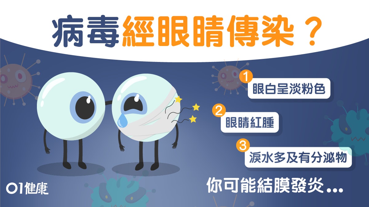 【武漢肺炎】病毒感染可致眼睛結膜發炎 戴隱形眼鏡及兒童風險高 【武漢肺炎】病毒感染可致眼睛結膜發炎 戴隱形眼鏡及兒童風險高