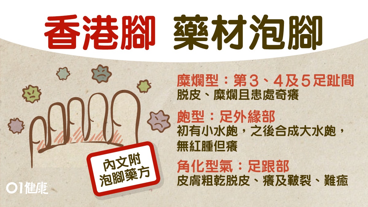 【香港腳】濕熱氣虛可致反覆發作 3類型香港腳之中最難愈是... 【香港腳】濕熱氣虛可致反覆發作 3類型香港腳之中最難愈是...