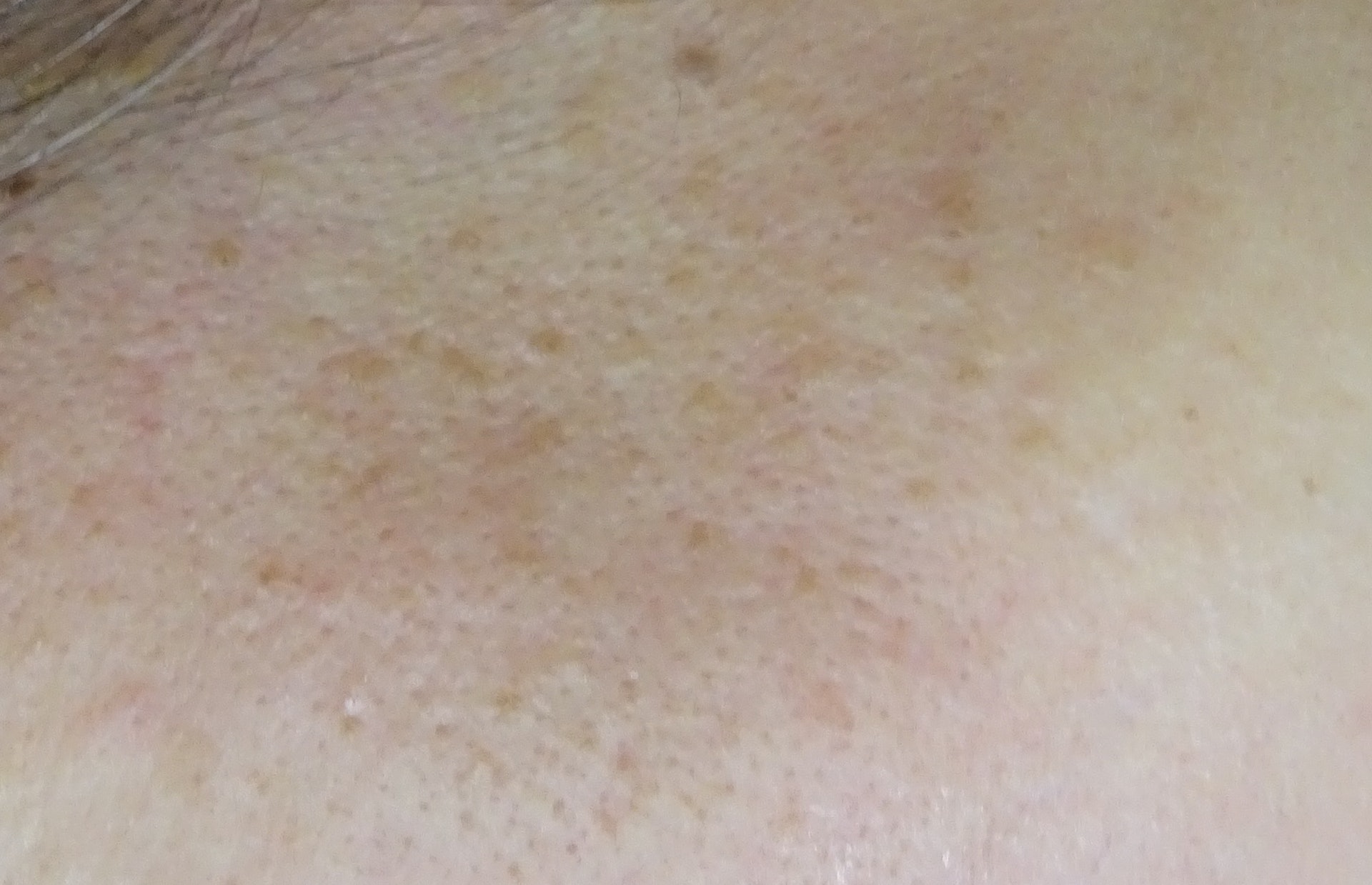 疣 暗瘡油脂粒 小心是疣亂挑會擴散按摩做瑜伽4類人易感染 香港01 健康 疣 暗瘡油脂粒 小心是疣亂挑會擴散按摩做瑜伽4類人易感染 香港01 健康