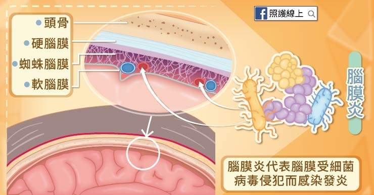 腦膜炎 初期病徵似流感突發高燒5大病徵慎防 燒壞腦 香港01 健康