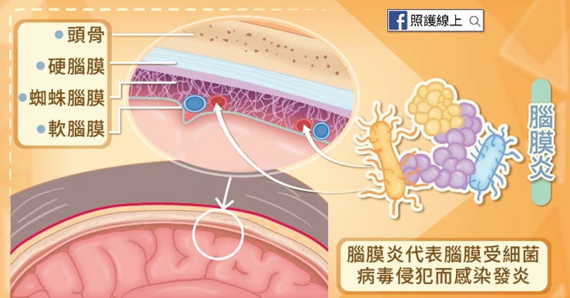 腦膜炎（照護線上授權使用）