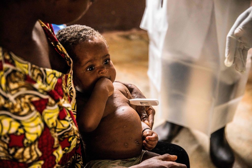猴痘（Monkeypox）：由2015至2017年间，先后在中非共和国及尼日利亚出现病例。（Getty Images）
