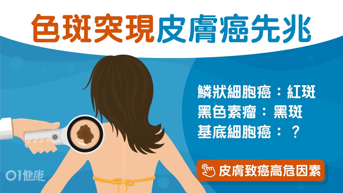 皮膚癌|哪些人易有皮膚癌?初期症狀、種類、自我檢測方法全公開 皮膚癌|哪些人易有皮膚癌?初期症狀、種類、自我檢測方法全公開