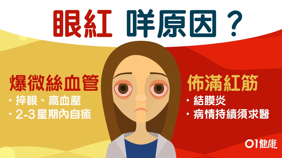 【眼紅】眼睛出血充血點分辨?紅筋持續須求醫鞏膜炎可致失明 【眼紅】眼睛出血充血點分辨?紅筋持續須求醫鞏膜炎可致失明