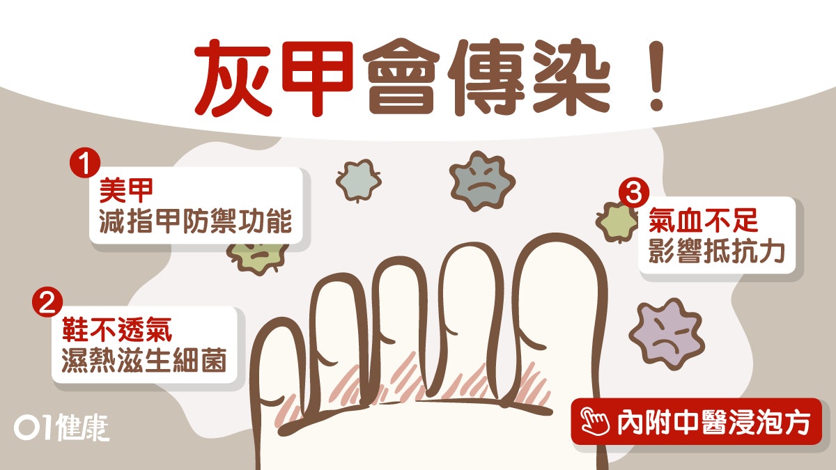 【灰甲】免疫力差穿錯鞋易感染?變色增厚小心傳染附2大浸泡配方 【灰甲】免疫力差穿錯鞋易感染?變色增厚小心傳染附2大浸泡配方