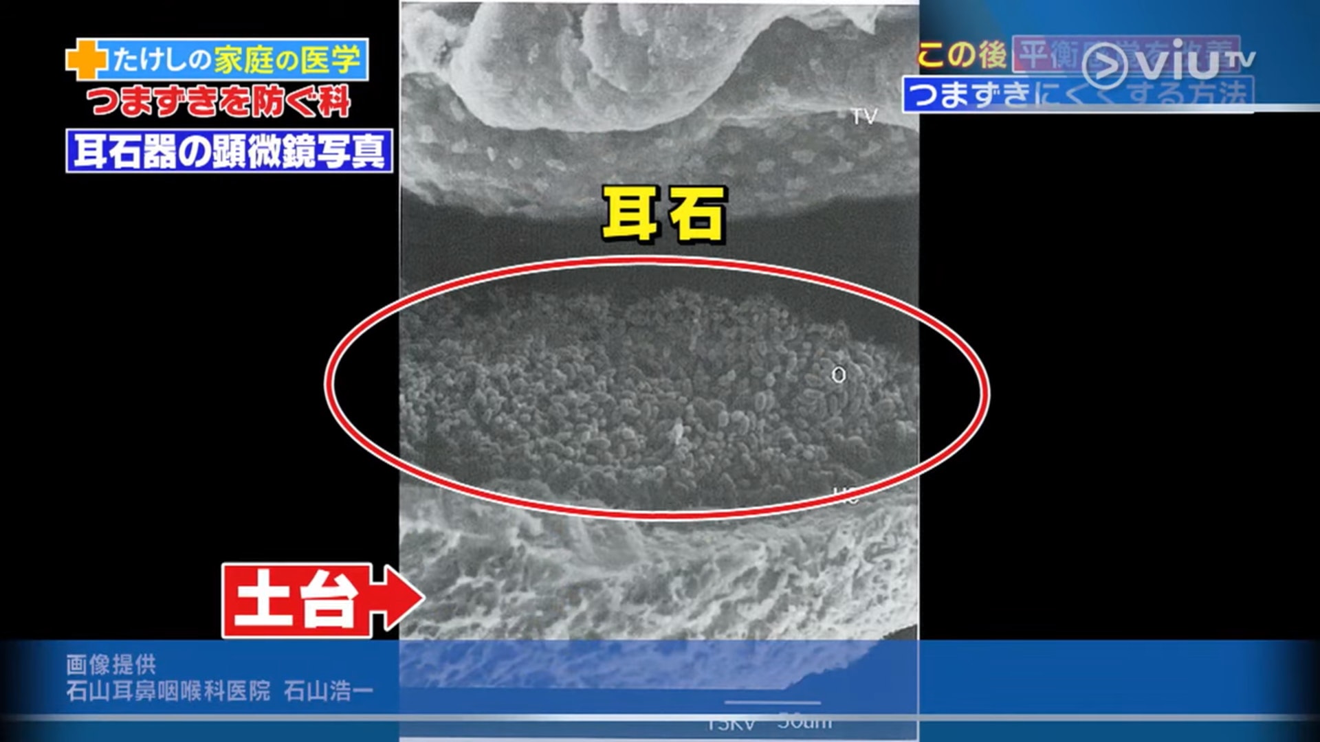 耳石器就好像一個碟般的基座,上面佈滿幾萬顆細小的耳石。(viu TV《恐怖醫學》影片截圖) 耳石器就好像一個碟般的基座,上面佈滿幾萬顆細小的耳石。(viu TV《恐怖醫學》影片截圖)