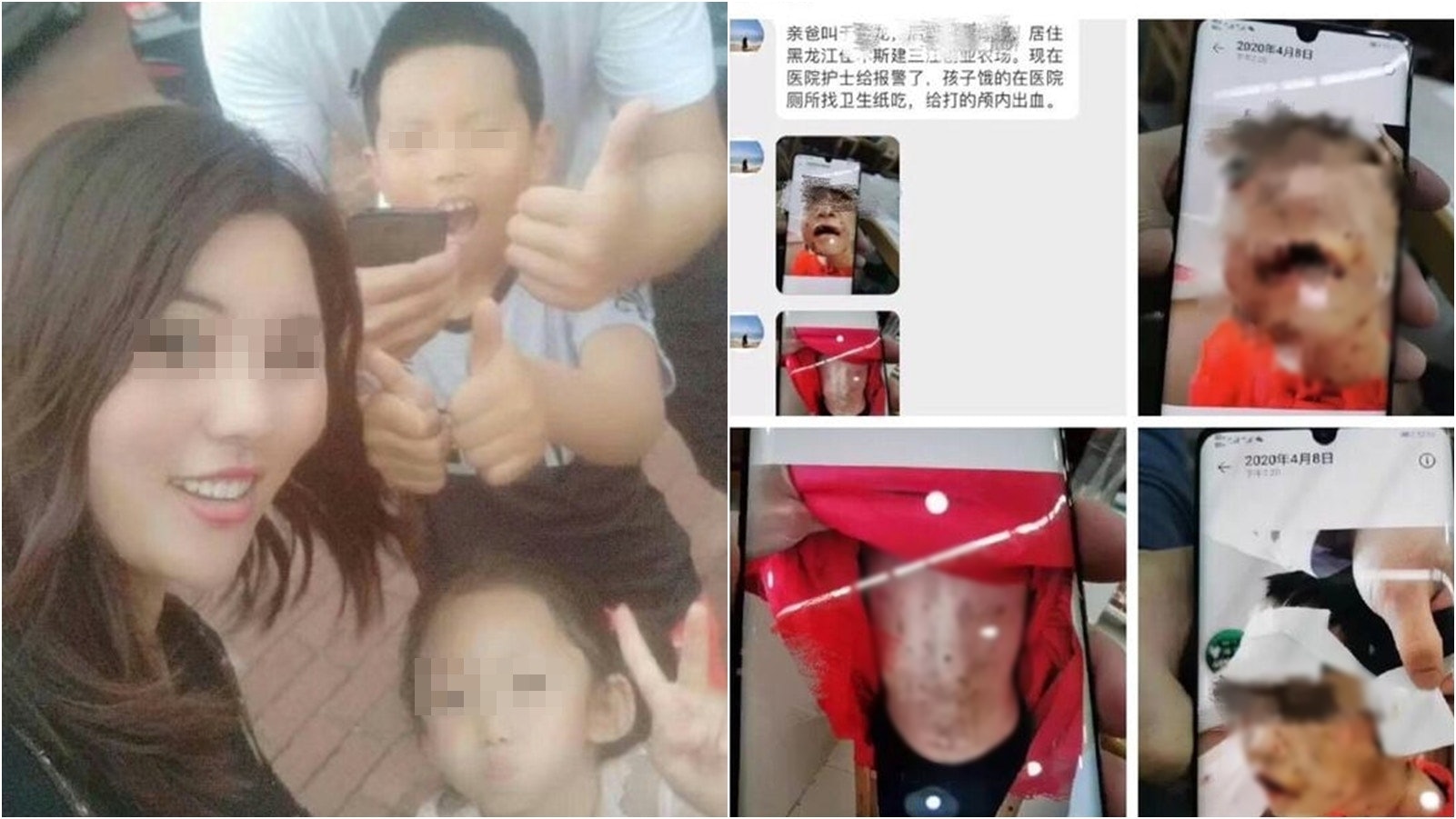 【傷重昏迷】黑龍江4歲女童遭家人虐打嘴唇被剪 父親及繼母被拘 【傷重昏迷】黑龍江4歲女童遭家人虐打嘴唇被剪 父親及繼母被拘