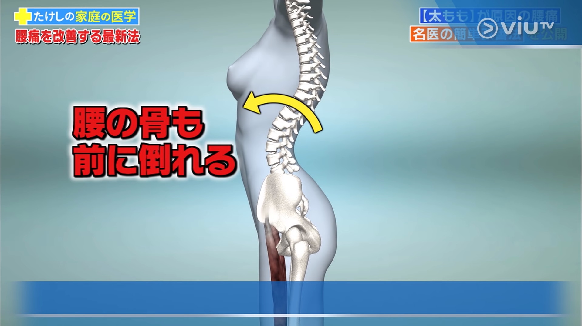 然後,接駁着盤骨的腰部亦繼而一同傾前。(viu TV《恐怖醫學》影片截圖) 然後,接駁着盤骨的腰部亦繼而一同傾前。(viu TV《恐怖醫學》影片截圖)