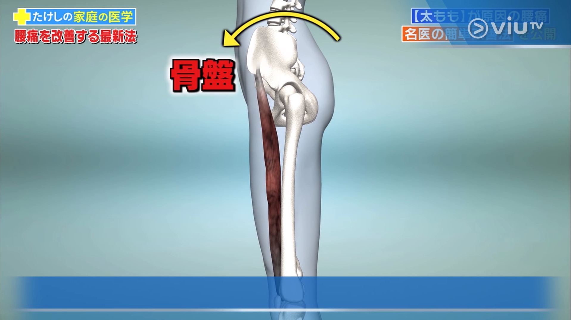 當肌肉無法伸展,連接肌肉的盤骨就容易被強行扯向前面,導致盤骨前傾。(viu TV《恐怖醫學》影片截圖) 當肌肉無法伸展,連接肌肉的盤骨就容易被強行扯向前面,導致盤骨前傾。(viu TV《恐怖醫學》影片截圖)