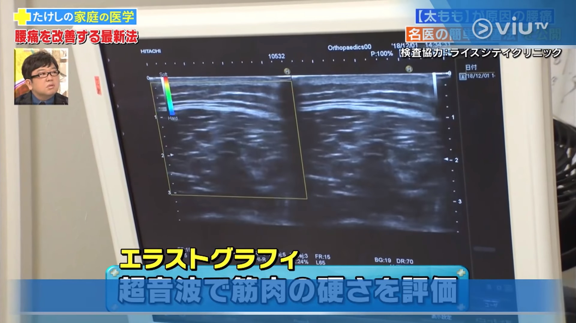 超聲波影像儀器檢查可評估大腿肌肉硬度（viu TV《恐怖醫學》影片截圖）