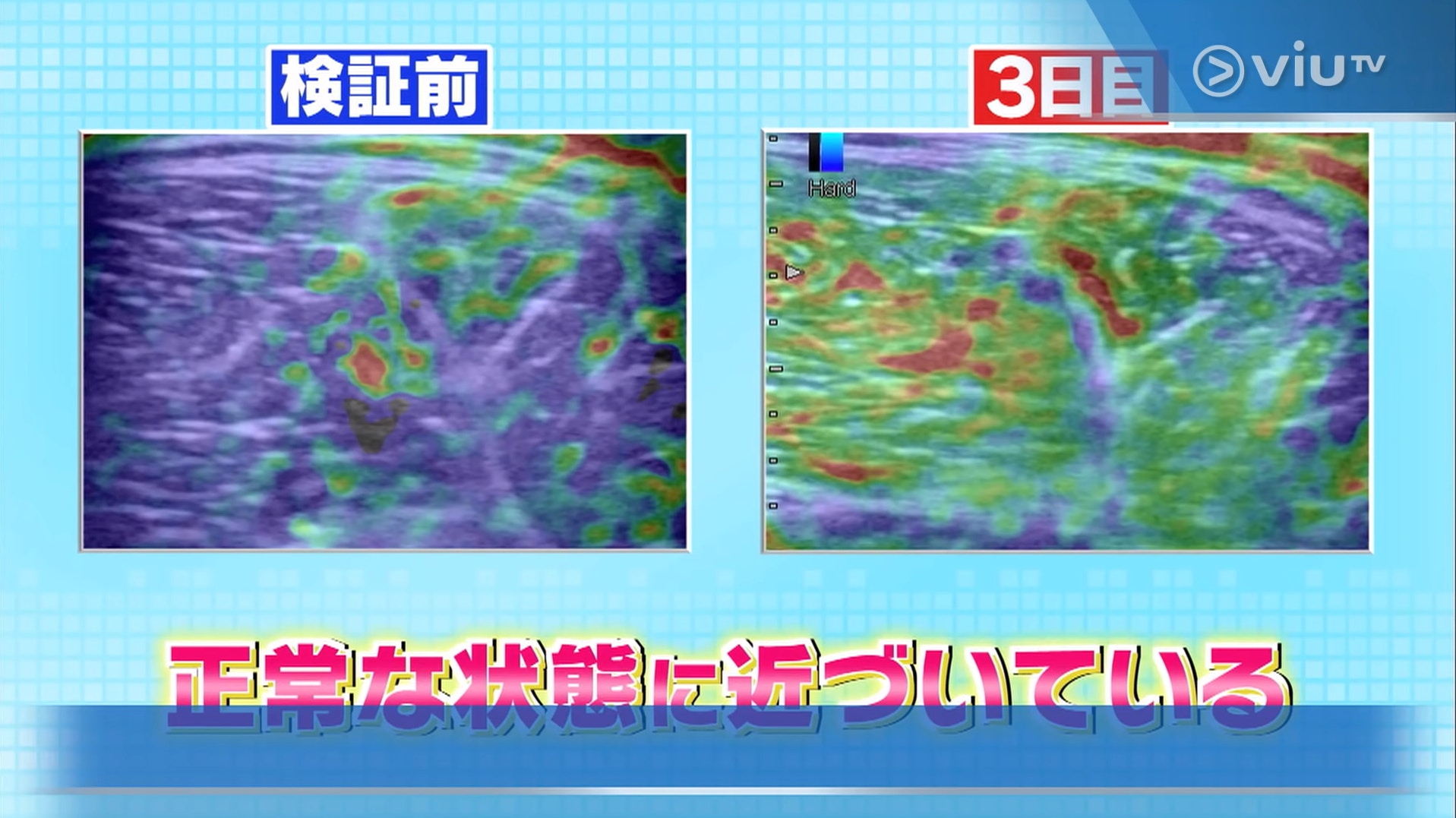 超聲波影像儀器檢查也顯示她的大腿肌肉硬度有很大的改善!(viu TV《恐怖醫學》影片截圖) 超聲波影像儀器檢查也顯示她的大腿肌肉硬度有很大的改善!(viu TV《恐怖醫學》影片截圖)