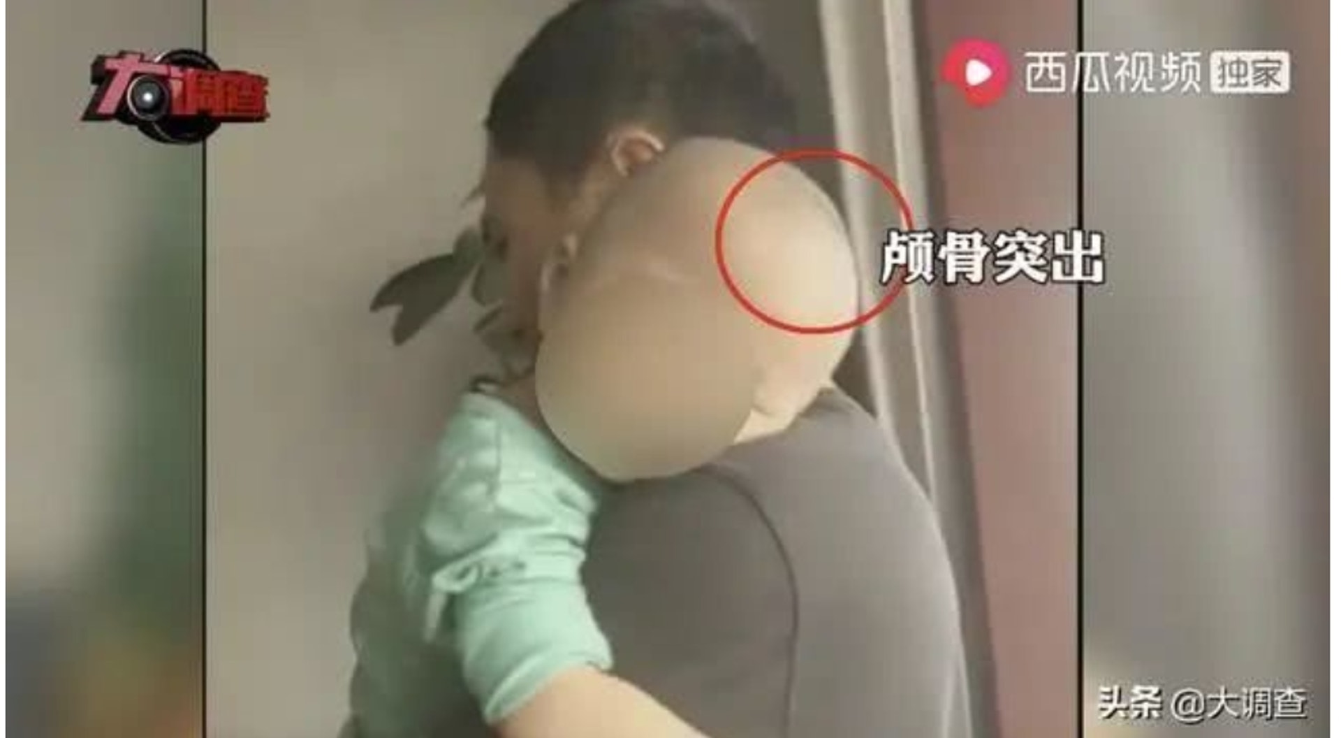 部分孩子的頭骨畸形酷似「大頭BB」。(微博) 部分孩子的頭骨畸形酷似「大頭BB」。(微博)