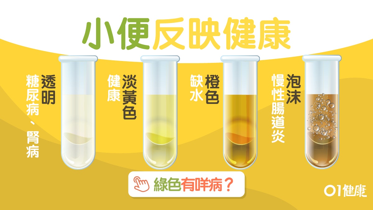尿色 深啡缺水起泡因腸道炎 7種尿液看健康每日應小便幾次 香港01 健康