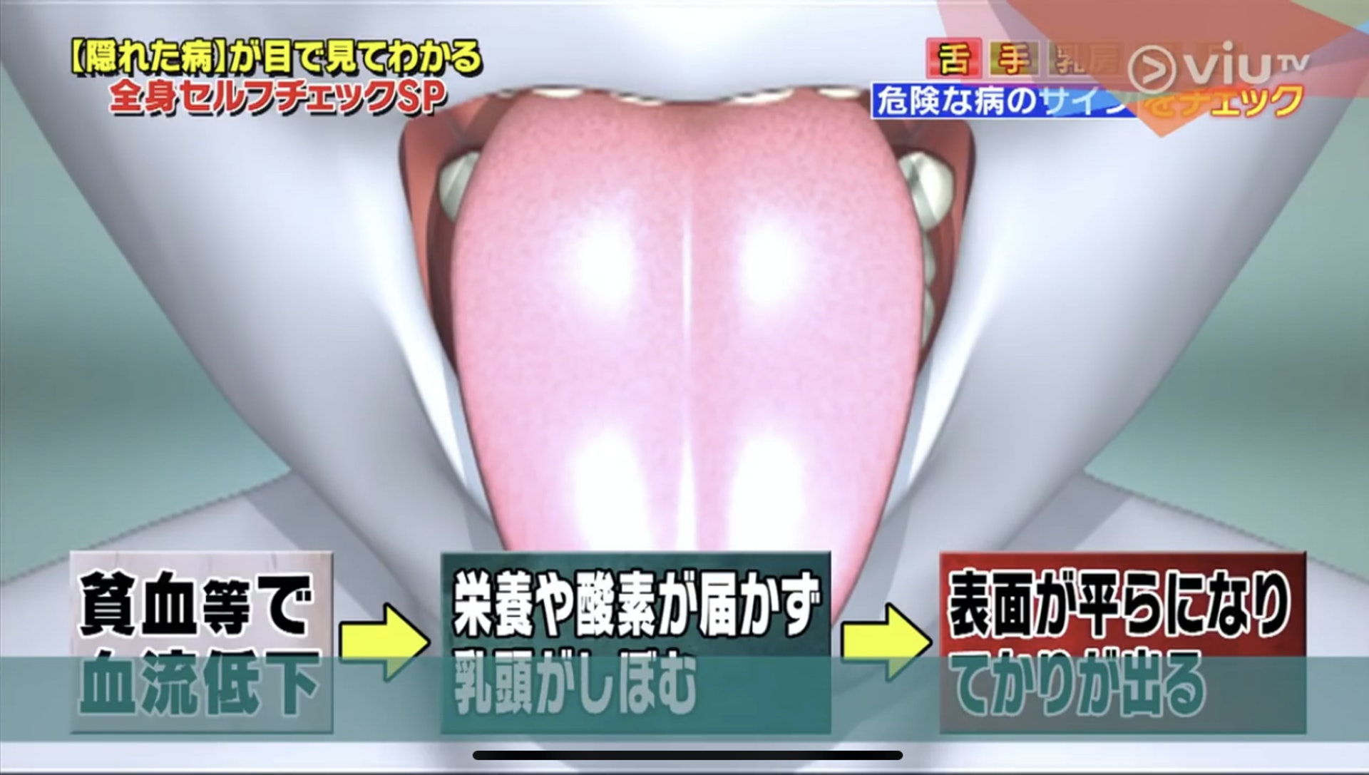 乳頭萎縮後，舌頭表面的突起物就消失，變得相當平滑。（Viu TV《恐怖醫學》影片截圖）