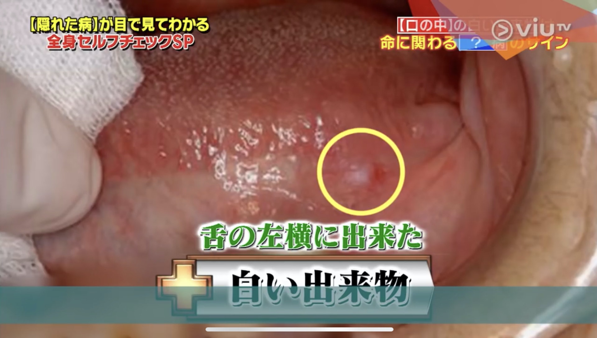 節目指出，舌頭出現小瘡可能是初期舌癌！（Viu TV《恐怖醫學》影片截圖）