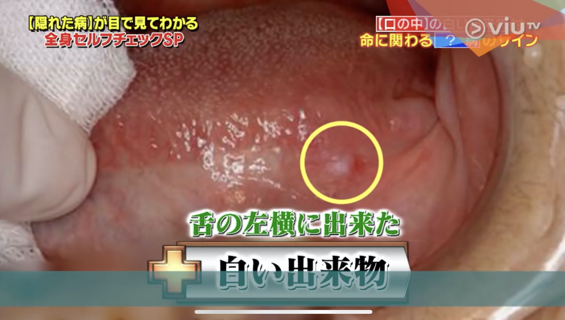 節目指出,舌頭出現小瘡可能是初期舌癌!(Viu TV《恐怖醫學》影片截圖) 節目指出,舌頭出現小瘡可能是初期舌癌!(Viu TV《恐怖醫學》影片截圖)