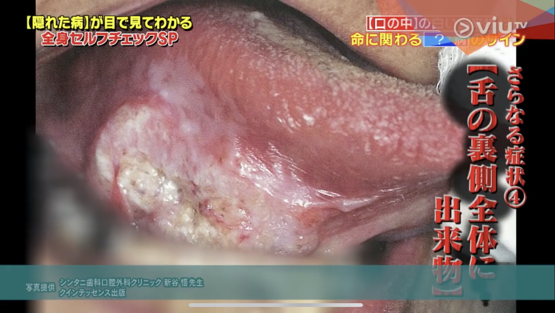 原本細小的白瘡,也會發大或蔓延至舌底等其他位置。(Viu TV《恐怖醫學》影片截圖) 原本細小的白瘡,也會發大或蔓延至舌底等其他位置。(Viu TV《恐怖醫學》影片截圖)
