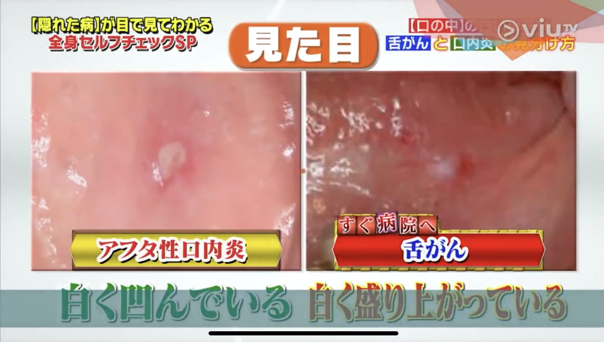 口腔炎造成的瘡,中央一般是凹下去;癌細胞則相反,中央會隆起。(Viu TV《恐怖醫學》影片截圖) 口腔炎造成的瘡,中央一般是凹下去;癌細胞則相反,中央會隆起。(Viu TV《恐怖醫學》影片截圖)