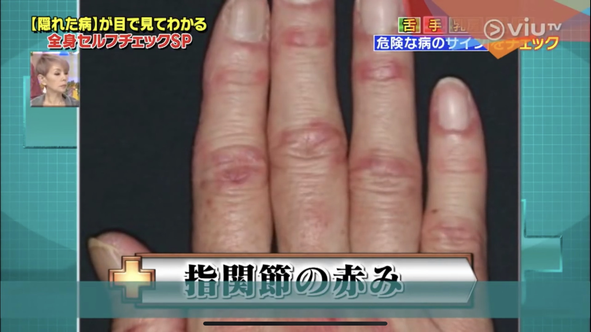 手指關節周圍發紅，還伴隨些腫脹，原來是皮肌炎的早期症狀。（Viu TV《恐怖醫學》影片截圖）