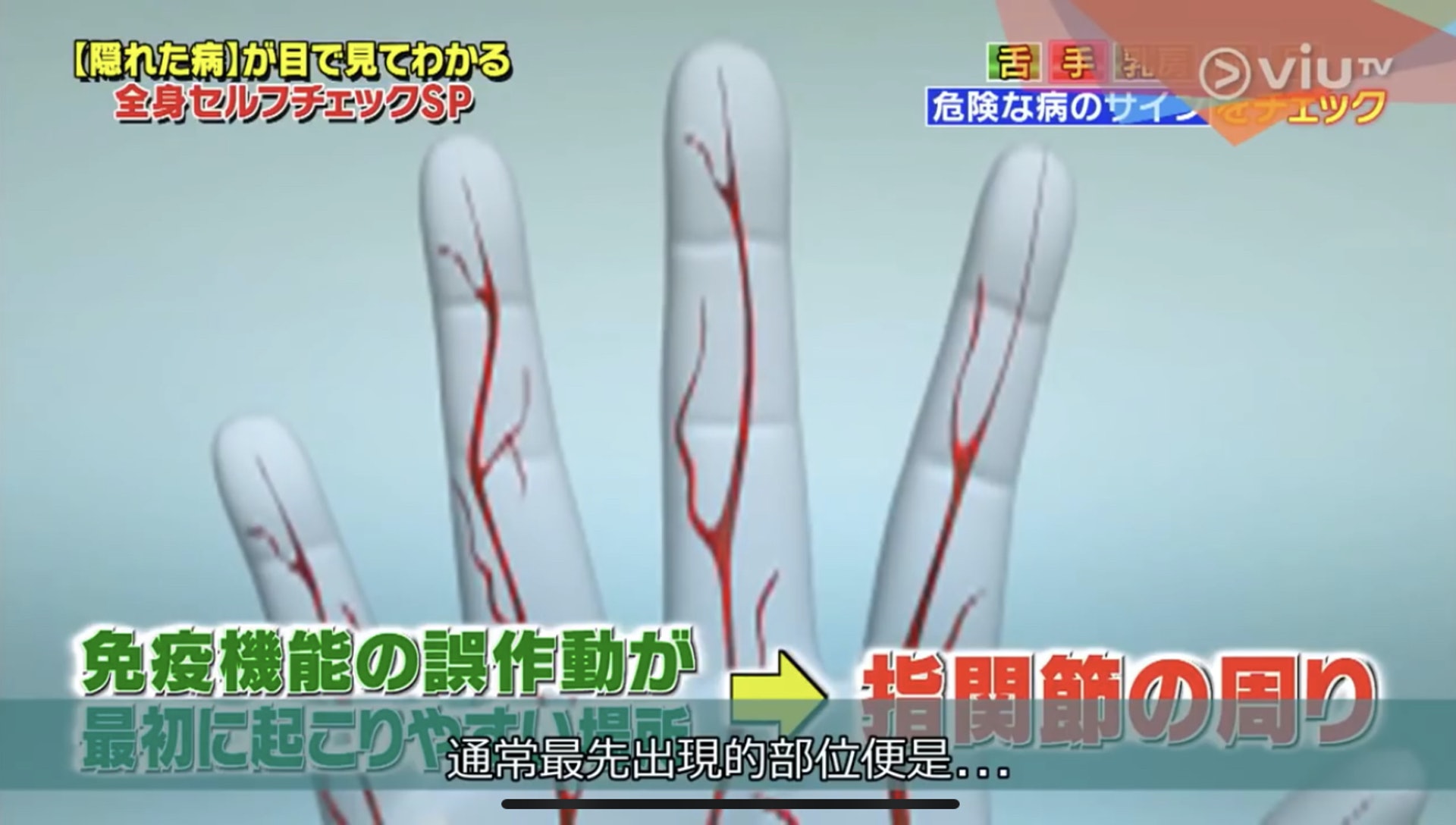 手指關節周圍紅腫，正是由於正常細胞受攻擊而發炎。（Viu TV《恐怖醫學》影片截圖）
