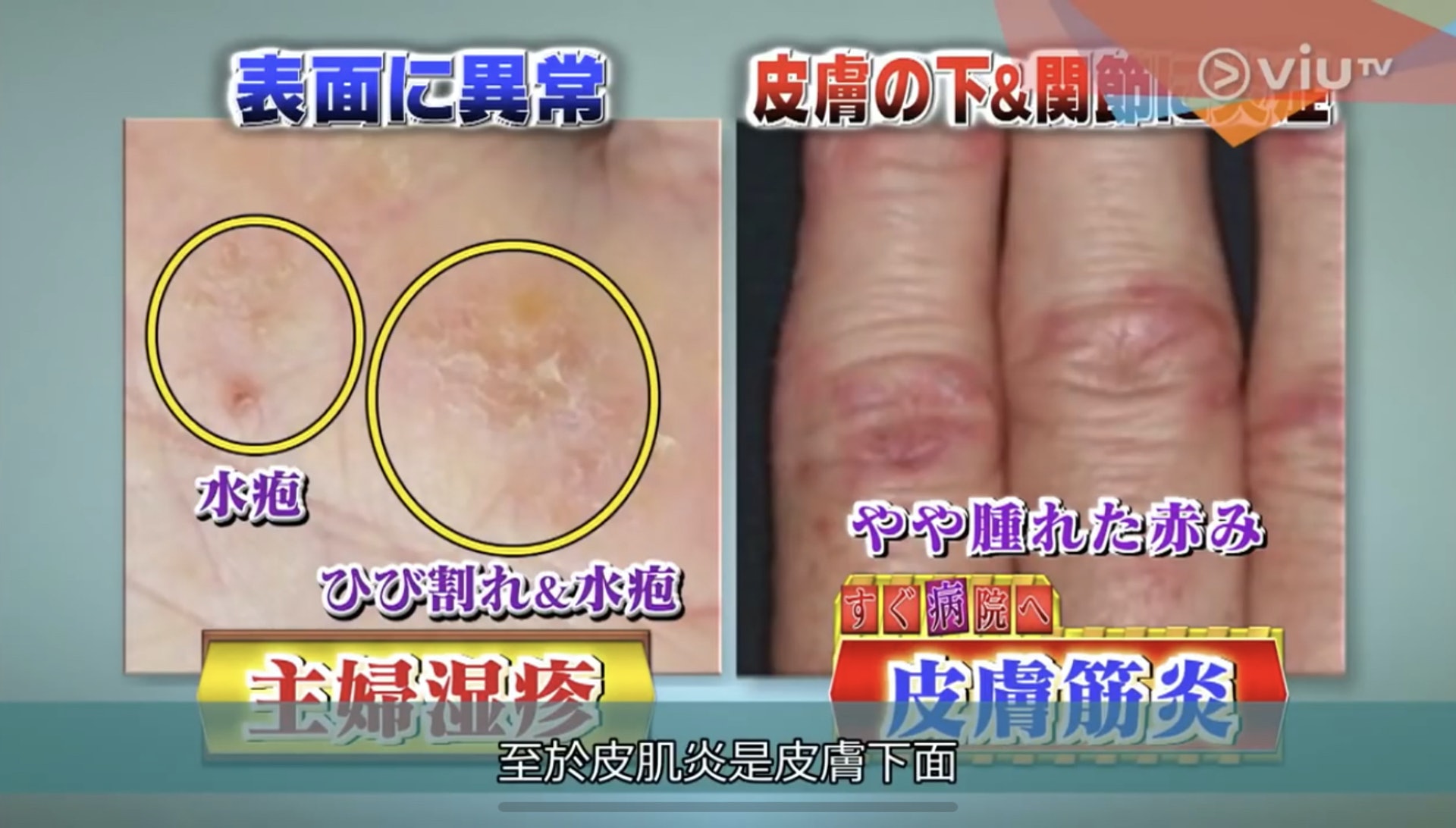 乾燥或濕疹主要會在皮膚表面造成症狀，皮肌炎導致的紅腫則是在皮膚下面。（Viu TV《恐怖醫學》影片截圖）
