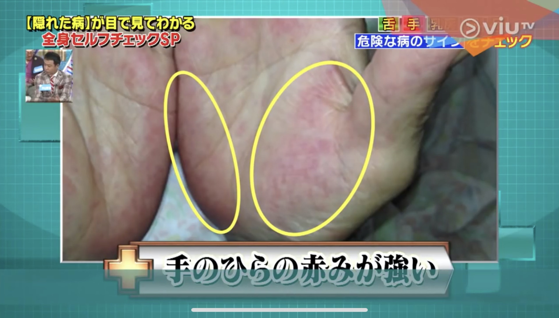 手掌上尾指和姆指下方的部分發紅可能是因慢性肝炎引起!((Viu TV《恐怖醫學》影片截圖)) 手掌上尾指和姆指下方的部分發紅可能是因慢性肝炎引起!((Viu TV《恐怖醫學》影片截圖))
