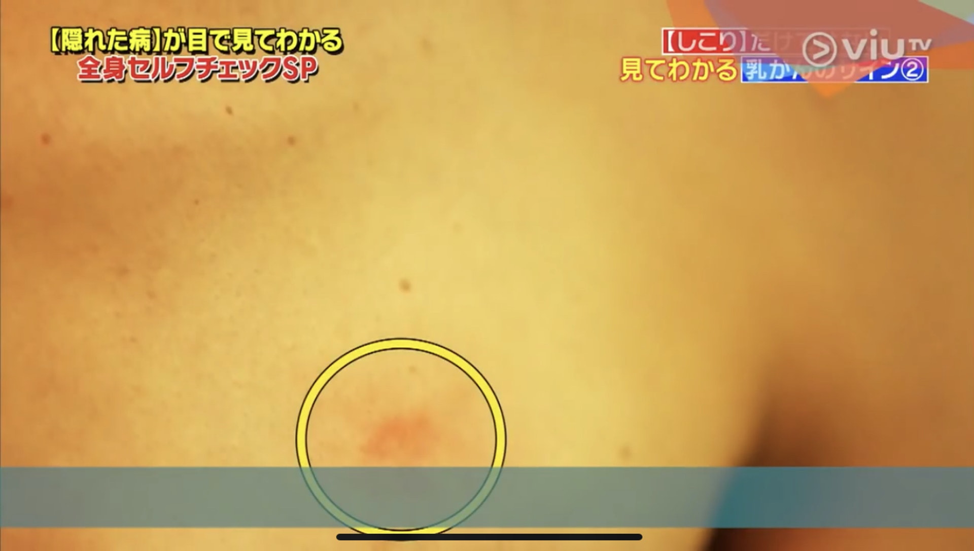 紅疹只有尾指甲般大,外形與皮膚敏感相似。(Viu TV《恐怖醫學》影片截圖) 紅疹只有尾指甲般大,外形與皮膚敏感相似。(Viu TV《恐怖醫學》影片截圖)