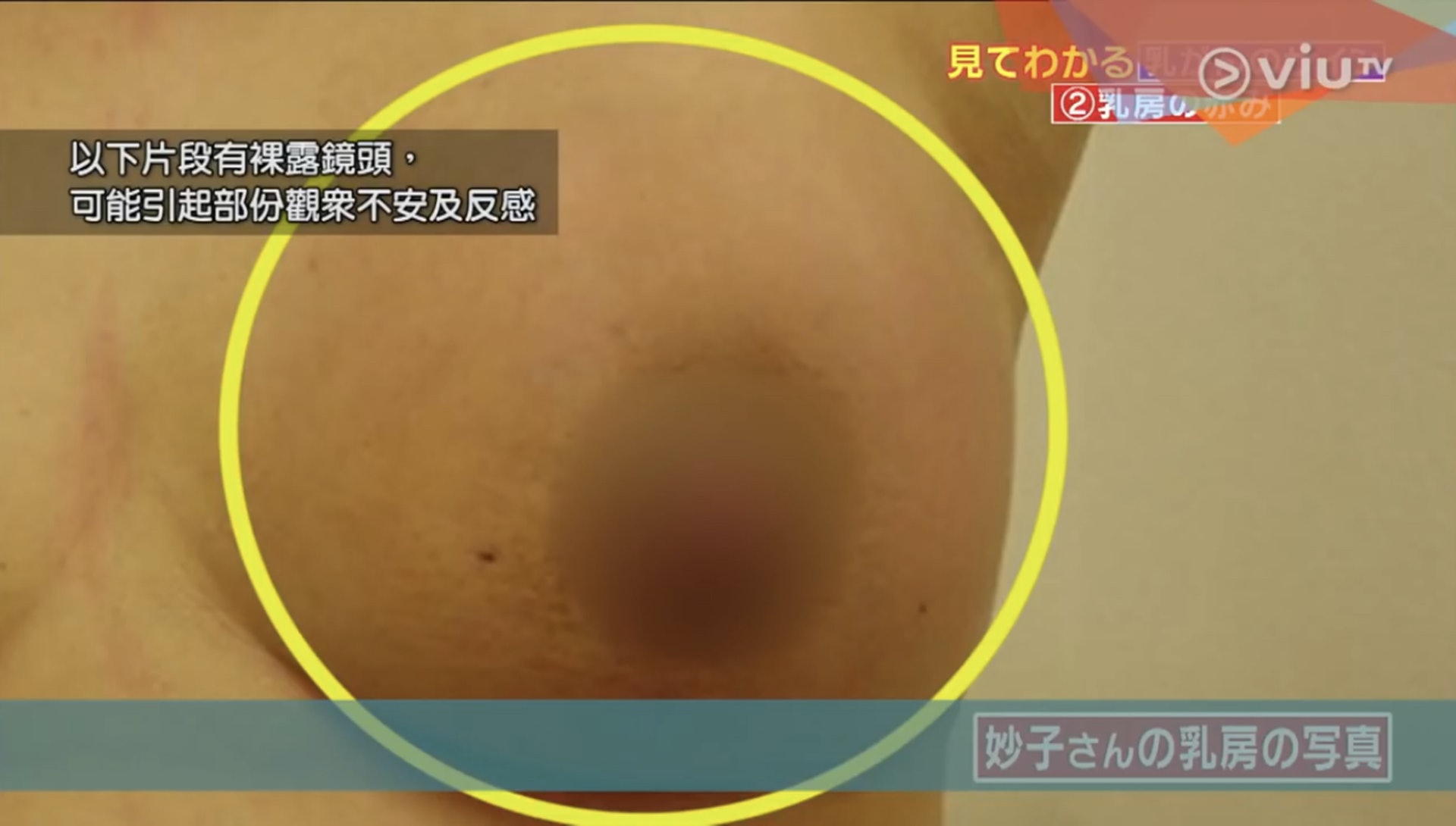 患者未有即時求診,紅疹最後卻擴散至全乳房!(Viu TV《恐怖醫學》影片截圖) 患者未有即時求診,紅疹最後卻擴散至全乳房!(Viu TV《恐怖醫學》影片截圖)