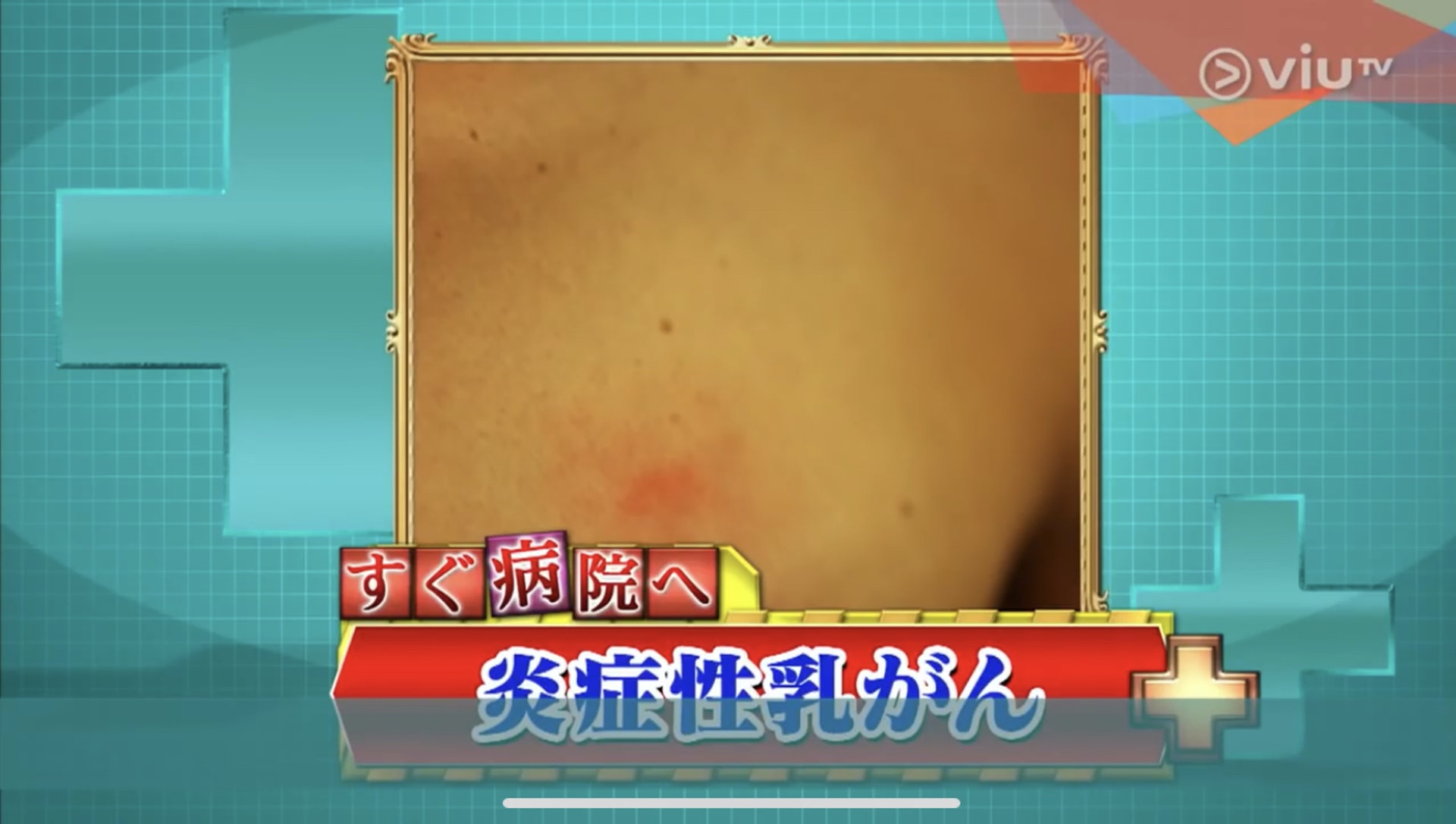 這種乳房紅疹原來是一種不會產生硬塊的乳癌——炎性乳腺癌的症狀。(Viu TV《恐怖醫學》影片截圖) 這種乳房紅疹原來是一種不會產生硬塊的乳癌——炎性乳腺癌的症狀。(Viu TV《恐怖醫學》影片截圖)