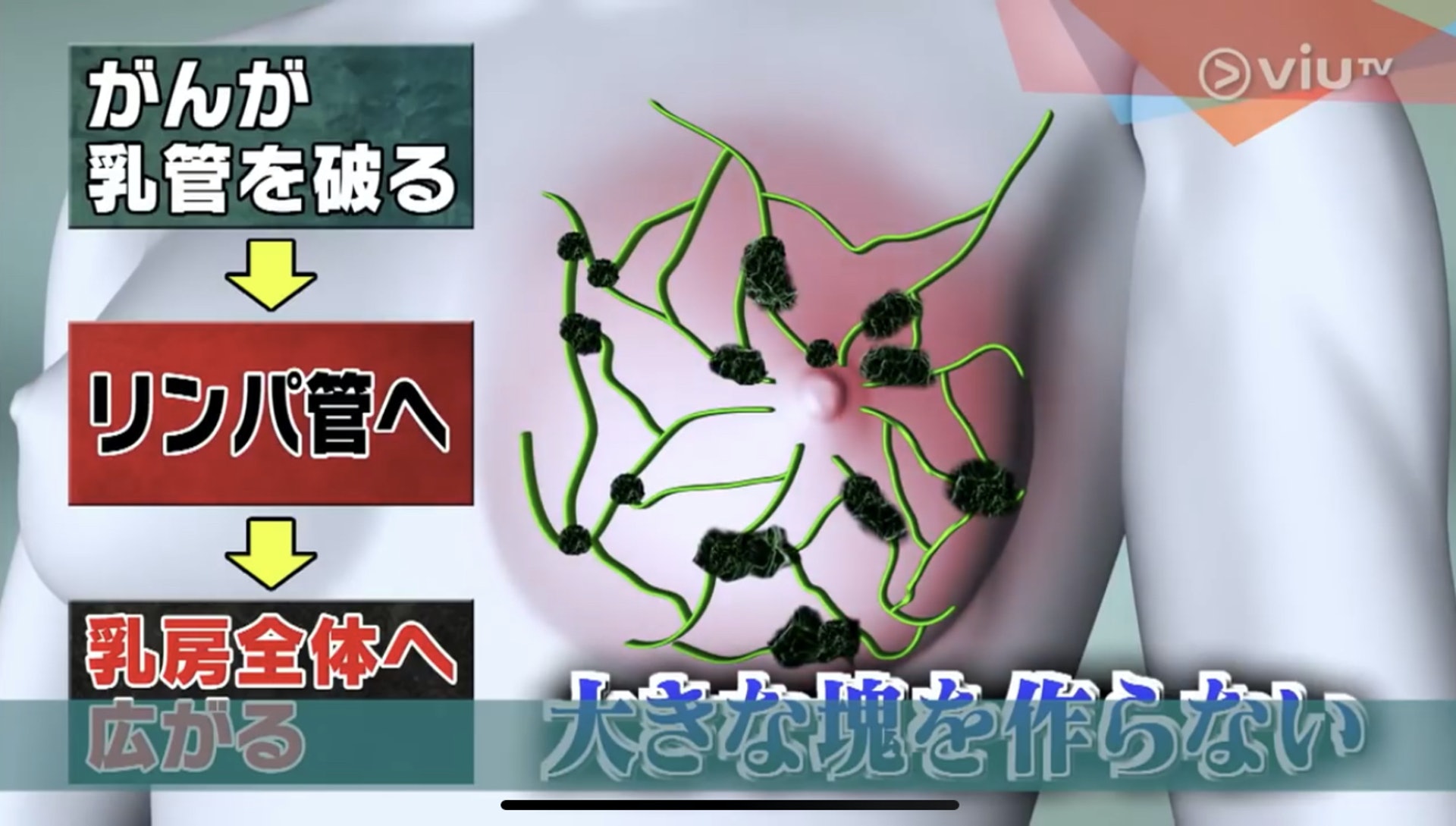 炎性乳腺癌的癌細胞會破壞乳腺後入侵淋巴腺,擴散到全乳。(Viu TV《恐怖醫學》影片截圖) 炎性乳腺癌的癌細胞會破壞乳腺後入侵淋巴腺,擴散到全乳。(Viu TV《恐怖醫學》影片截圖)